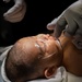 Cleft Lip Surgery Aboard USNS Comfort CP25