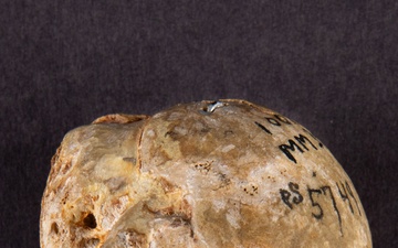 Head of the Right Humerus of Union Army Pvt. Michael Punch