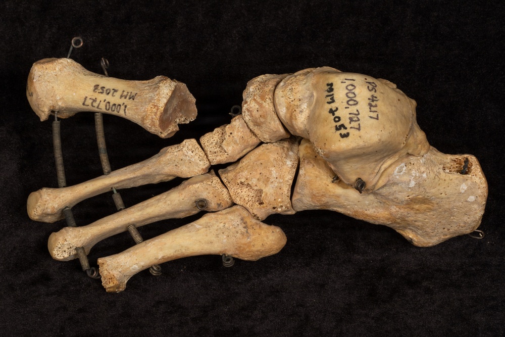 Battle of Franklin Anatomical Specimen