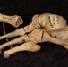 Battle of Franklin Anatomical Specimen