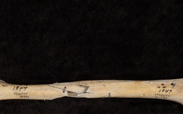 Battle of Fredericksburg Anatomical Specimen