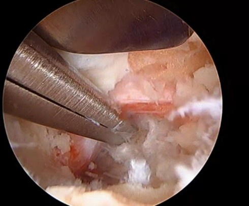 U.S. Naval Hospital Okinawa Offers New Spinal Procedure for Pain Relief