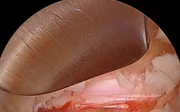 U.S. Naval Hospital Okinawa Offers New Spinal Procedure for Pain Relief