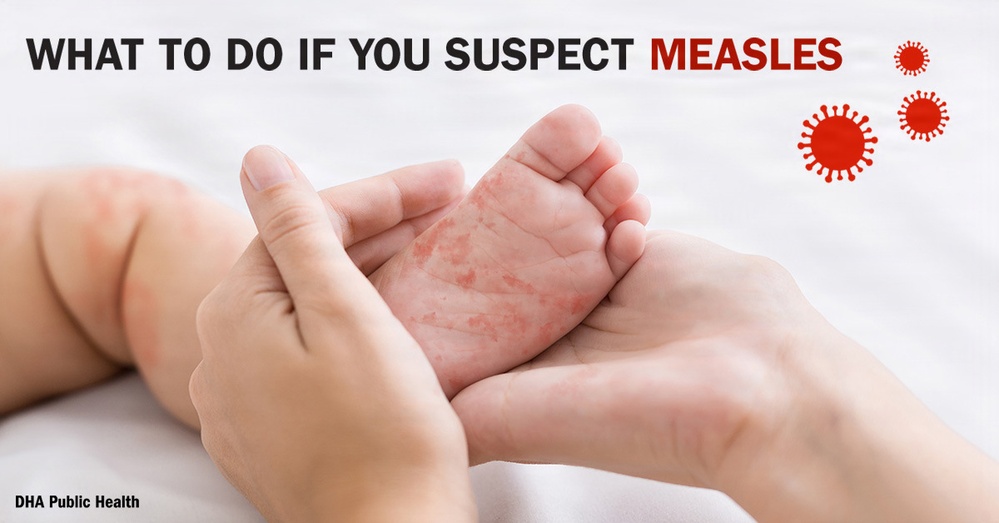 Measles - What to do if you suspect measles