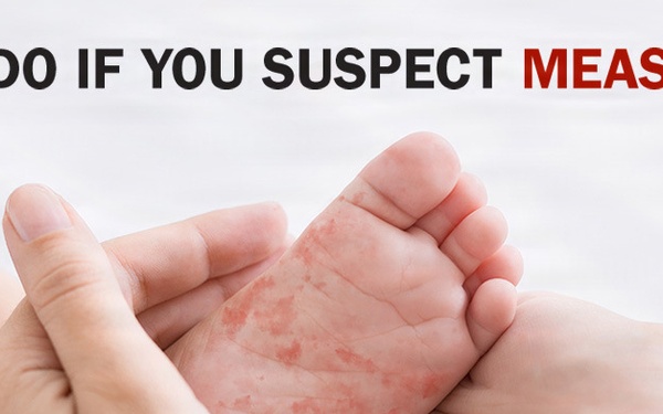 Measles - What to do if you suspect measles