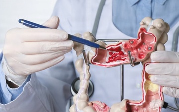 Colorectal cancer: Get screened, stressed Walter Reed surgeon