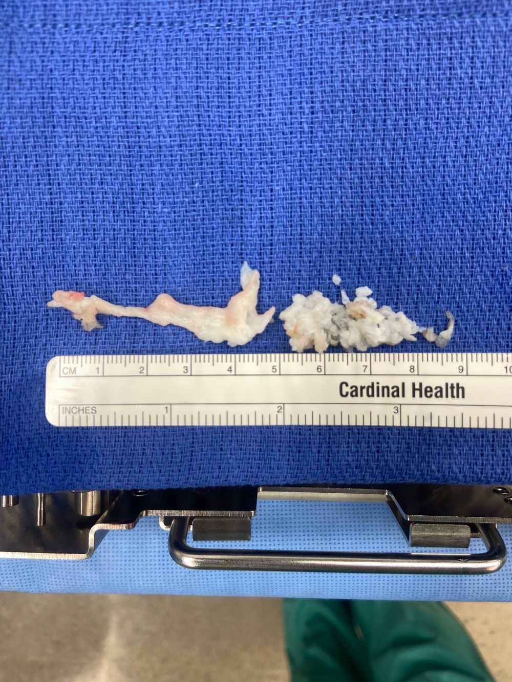 Advancing Spine Surgery in the Pacific:  First Uniportal Endoscopic Procedure at Naval Hospital Okinawa