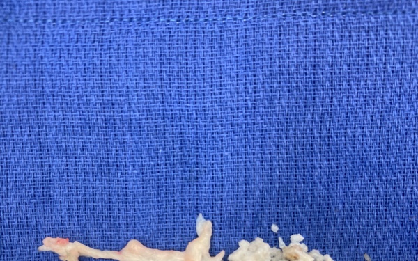 Advancing Spine Surgery in the Pacific:  First Uniportal Endoscopic Procedure at Naval Hospital Okinawa