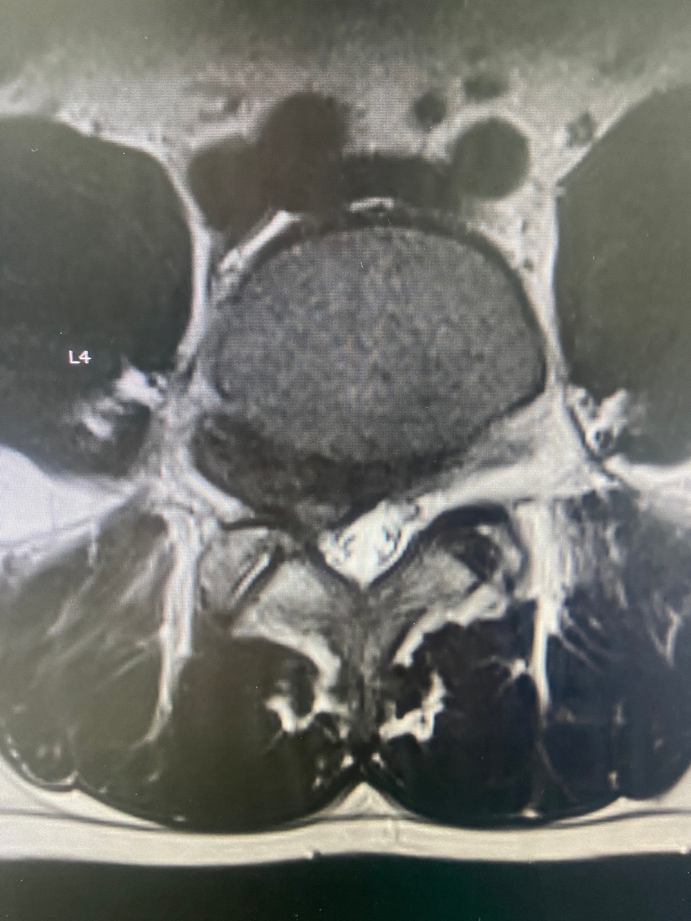 Advancing Spine Surgery in the Pacific:  First Uniportal Endoscopic Procedure at Naval Hospital Okinawa