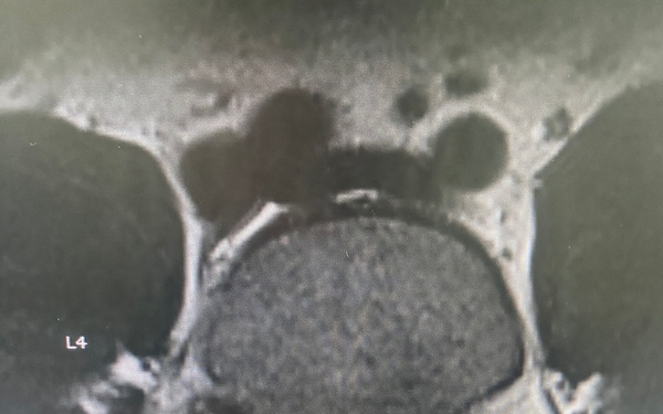 Advancing Spine Surgery in the Pacific:  First Uniportal Endoscopic Procedure at Naval Hospital Okinawa