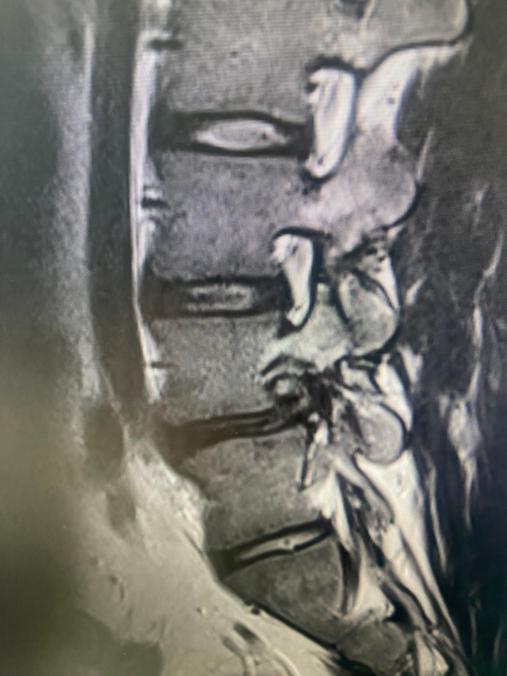 Advancing Spine Surgery in the Pacific:  First Uniportal Endoscopic Procedure at Naval Hospital Okinawa