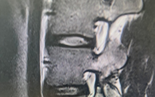 Advancing Spine Surgery in the Pacific:  First Uniportal Endoscopic Procedure at Naval Hospital Okinawa