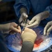 Walter Reed Organ Transplant Service team performs kidney transplant