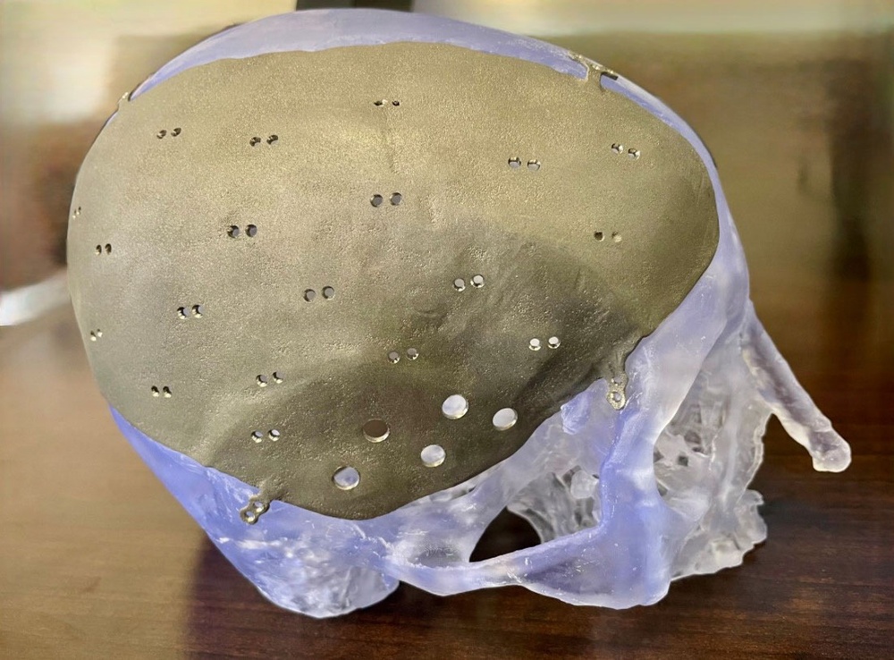 A perfect fit: Walter Reed becomes first point-of-care facility to receive FDA clearance for patient-specific implant