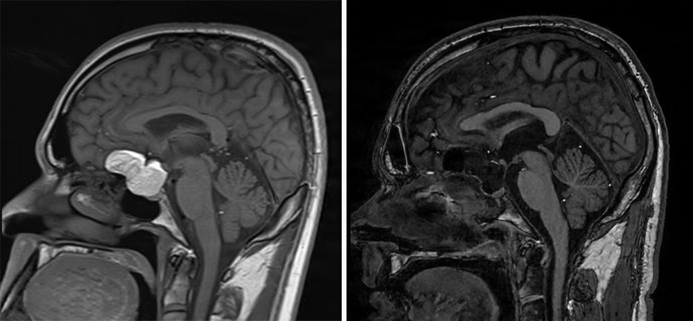 Walter Reed’s Skull Base Team performs minimally invasive brain tumor removal on U.S. Marine Corps SNCO