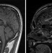 Walter Reed’s Skull Base Team performs minimally invasive brain tumor removal on U.S. Marine Corps SNCO