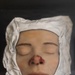 Syphilis Exhibit
