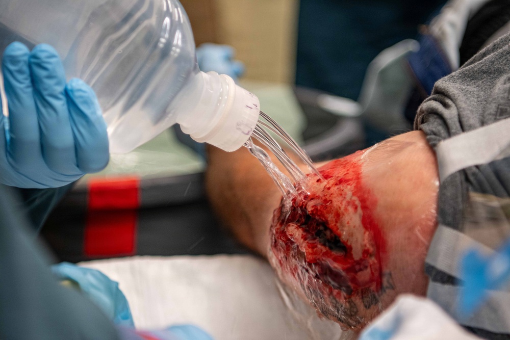 A medical professional wearing blue nitrile gloves is irrigating a severe traumatic wound on what appears to be a patient's lower leg or ankle using a saline or sterile water bottle. The wound shows significant tissue damage with active bleeding and possible debris. This appears to be an emergency or trauma care setting.