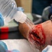 A medical professional wearing blue nitrile gloves is irrigating a severe traumatic wound on what appears to be a patient's lower leg or ankle using a saline or sterile water bottle. The wound shows significant tissue damage with active bleeding and possible debris. This appears to be an emergency or trauma care setting.