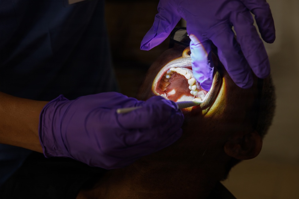 A dental professional wearing purple nitrile gloves is performing an oral examination on a patient whose mouth is wide open. A light source is being used to illuminate the oral cavity, allowing visibility of the teeth and soft tissues. The image is taken from a close-up overhead angle in a dimly lit clinical setting.