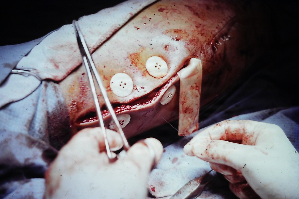 This appears to be a historical surgical or medical procedure photograph showing a wound closure or repair technique using buttons as bolsters to distribute suture tension across tissue. The image shows gloved hands manipulating surgical needles and sutures, with multiple white buttons used as anchoring devices over what appears to be a sutured wound. This technique, using buttons to prevent sutures from tearing through tissue, was historically employed in wound closure under high tension.