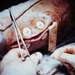 This appears to be a historical surgical or medical procedure photograph showing a wound closure or repair technique using buttons as bolsters to distribute suture tension across tissue. The image shows gloved hands manipulating surgical needles and sutures, with multiple white buttons used as anchoring devices over what appears to be a sutured wound. This technique, using buttons to prevent sutures from tearing through tissue, was historically employed in wound closure under high tension.